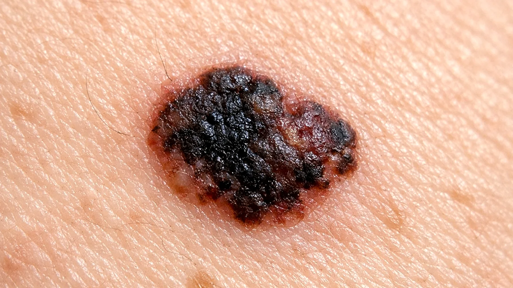 Czerniak: jak go rozpoznać – przewodnik po pierwszych oznakach i sygnałach alarmowych, które warto znać"